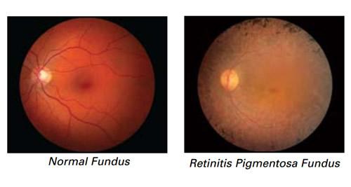 normal retina vs retinitis pigmentosa